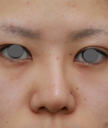 隆鼻術（シリコンプロテーゼ）,鼻のシリコンプロテーゼ抜き（除去）,他院で受けた手術の修正（鼻）,他院で入れたL型プロテーゼをI型プロテーゼに入れ替えて修正した症例写真,Before,ba_ryubi37_b.jpg