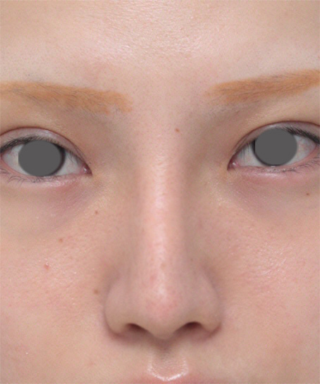 ヒアルロン酸分解・溶解（ヒアルロニダーゼ注射）,鼻にヒアルロン酸が入っている方に、プロテーゼ+耳介軟骨移植+鼻翼縮小を行った症例写真,After（メイクあり）,