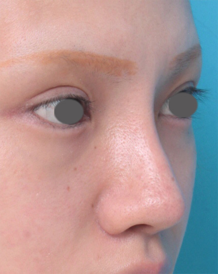ヒアルロン酸分解・溶解（ヒアルロニダーゼ注射）,鼻にヒアルロン酸が入っている方に、プロテーゼ+耳介軟骨移植+鼻翼縮小を行った症例写真,After（メイクあり）,
