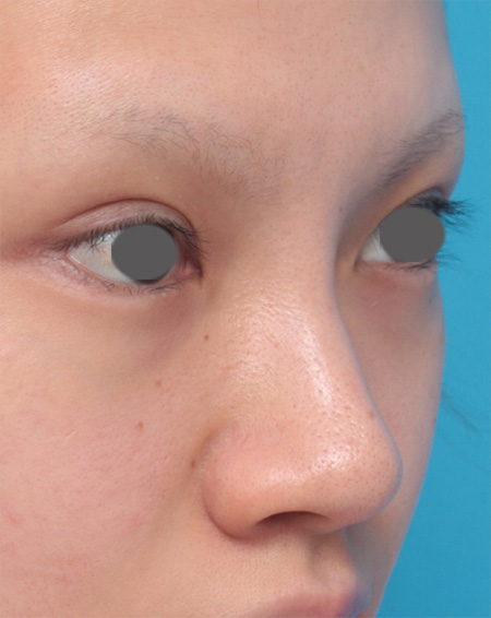 隆鼻術（シリコンプロテーゼ）,鼻にヒアルロン酸が入っている方に、プロテーゼ+耳介軟骨移植+鼻翼縮小を行った症例写真,Before,ba_ryubi41_b.jpg