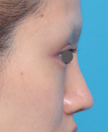 鼻翼縮小（小鼻縮小）,鼻にヒアルロン酸が入っている方に、プロテーゼ+耳介軟骨移植+鼻翼縮小を行った症例写真,After（メイクなし）,ba_ryubi42_b.jpg