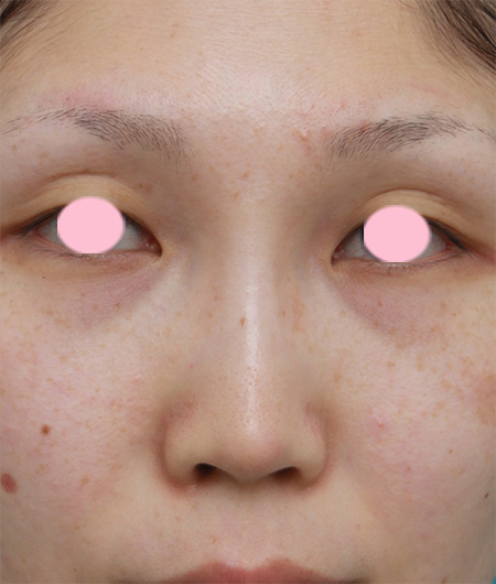 鼻プロテーゼ＋耳介軟骨移植の症例写真,After（2ヶ月後）,ba_ryubi43_a01.jpg