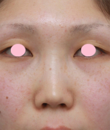 隆鼻術（シリコンプロテーゼ）,鼻プロテーゼ＋耳介軟骨移植の症例写真,Before,ba_ryubi43_b.jpg