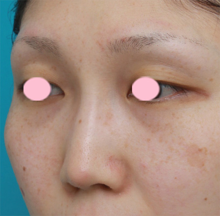 隆鼻術（シリコンプロテーゼ）,鼻プロテーゼ＋耳介軟骨移植の症例写真,After（2ヶ月後）,ba_ryubi44_b.jpg