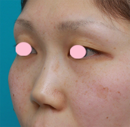 隆鼻術（シリコンプロテーゼ）,鼻プロテーゼ＋耳介軟骨移植の症例写真,Before,ba_ryubi44_b.jpg