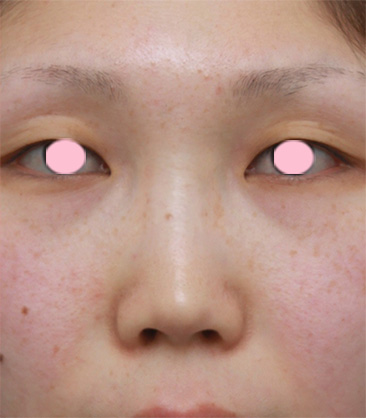 隆鼻術（シリコンプロテーゼ）,鼻プロテーゼ＋耳介軟骨移植の症例写真,手術前,mainpic_ryubi11a.jpg
