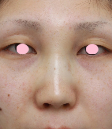 隆鼻術（シリコンプロテーゼ）,鼻プロテーゼ＋耳介軟骨移植の症例写真,手術直後,mainpic_ryubi11b.jpg