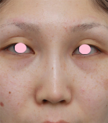 症例写真,鼻プロテーゼ＋耳介軟骨移植の症例写真,2ヶ月後,mainpic_ryubi11c.jpg