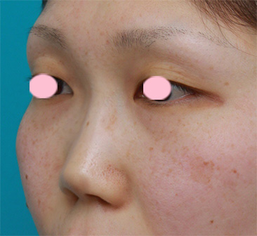 隆鼻術（シリコンプロテーゼ）,鼻プロテーゼ＋耳介軟骨移植の症例写真,手術前,mainpic_ryubi11d.jpg