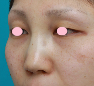 隆鼻術（シリコンプロテーゼ）,鼻プロテーゼ＋耳介軟骨移植の症例写真,手術直後,mainpic_ryubi11e.jpg