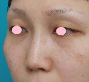 症例写真,鼻プロテーゼ＋耳介軟骨移植の症例写真,2ヶ月後,mainpic_ryubi11f.jpg