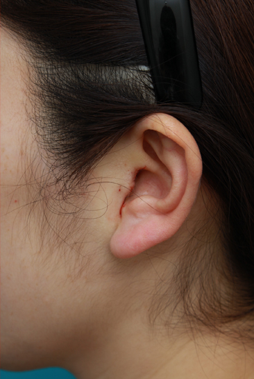 隆鼻術（シリコンプロテーゼ）,鼻プロテーゼ＋耳介軟骨移植の症例写真,手術直後,mainpic_ryubi11g.jpg