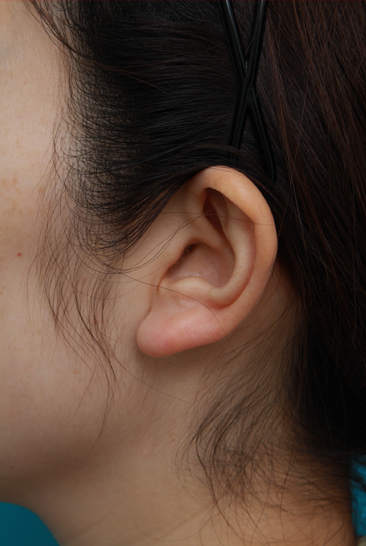 隆鼻術（シリコンプロテーゼ）,鼻プロテーゼ＋耳介軟骨移植の症例写真,2ヶ月後,mainpic_ryubi11h.jpg