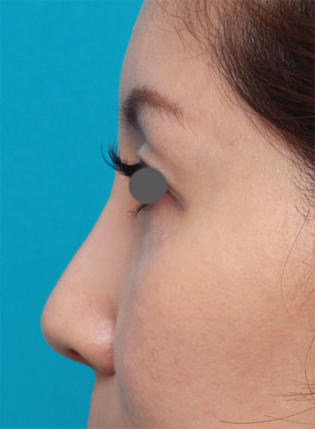 隆鼻術（シリコンプロテーゼ）,2.5mmのI型プロテーゼを入れて、知り合いに気付かれないように鼻を高くした症例写真,After（1ヶ月後）,ba_ryubi47_b.jpg