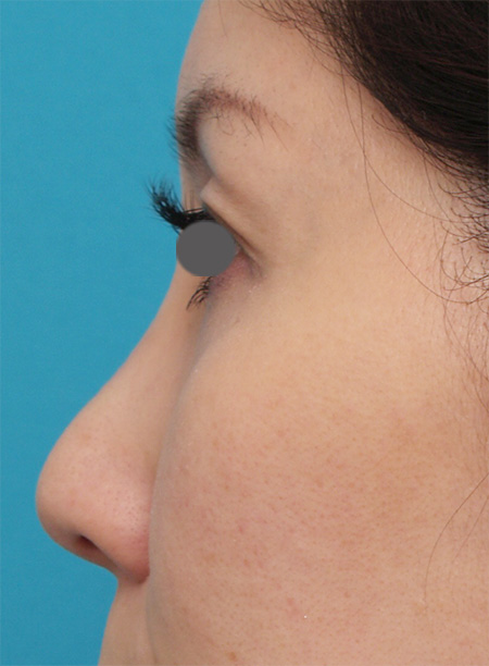 隆鼻術（シリコンプロテーゼ）,2.5mmのI型プロテーゼを入れて、知り合いに気付かれないように鼻を高くした症例写真,Before,ba_ryubi47_b.jpg