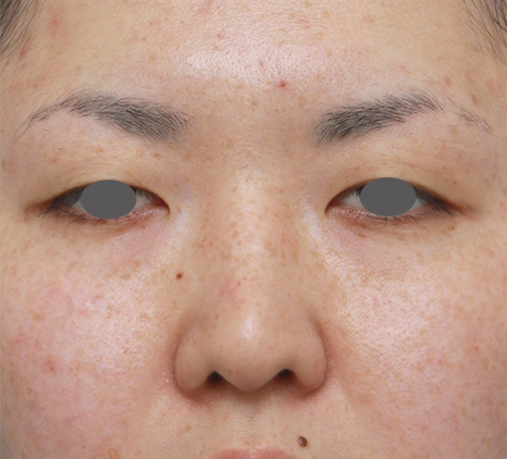 鼻シリコンプロテーゼ+鼻先の耳介軟骨移植症例写真,Before,ba_ryubi48_b.jpg
