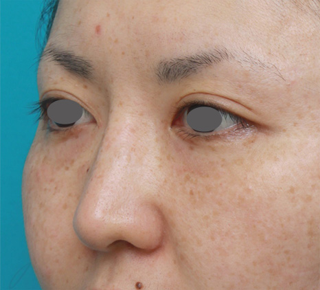隆鼻術（シリコンプロテーゼ）,鼻シリコンプロテーゼ+鼻先の耳介軟骨移植症例写真,After（3ヶ月後）,ba_ryubi49_b.jpg