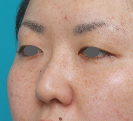 隆鼻術（シリコンプロテーゼ）,鼻シリコンプロテーゼ+鼻先の耳介軟骨移植症例写真,Before,ba_ryubi49_b.jpg