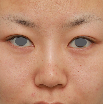鼻翼縮小（小鼻縮小）,鼻のシリコンプロテーゼ+鼻翼（小鼻）縮小手術の症例写真,After（6ヶ月後）,ba_ryubi55_b.jpg