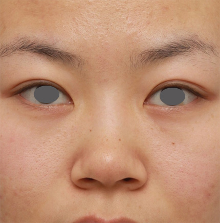 鼻翼縮小（小鼻縮小）,鼻のシリコンプロテーゼ+鼻翼（小鼻）縮小手術の症例写真,Before,ba_ryubi55_b.jpg