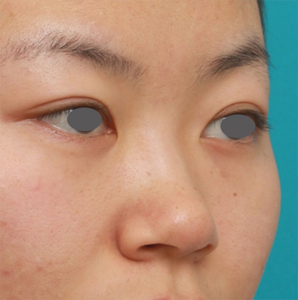 鼻翼縮小（小鼻縮小）,鼻のシリコンプロテーゼ+鼻翼（小鼻）縮小手術の症例写真,Before,ba_ryubi56_b.jpg