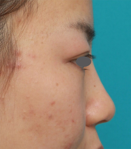 鼻翼縮小（小鼻縮小）,鼻のシリコンプロテーゼ+鼻翼（小鼻）縮小手術の症例写真,After（6ヶ月後）,ba_ryubi57_b.jpg