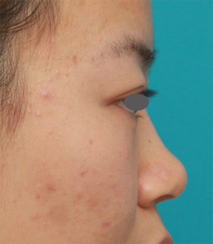 隆鼻術（シリコンプロテーゼ）,鼻のシリコンプロテーゼ+鼻翼（小鼻）縮小手術の症例写真,Before,ba_ryubi57_b.jpg