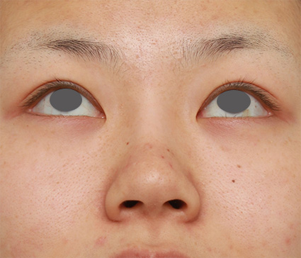 鼻翼縮小（小鼻縮小）,鼻のシリコンプロテーゼ+鼻翼（小鼻）縮小手術の症例写真,After（6ヶ月後）,ba_ryubi58_b.jpg