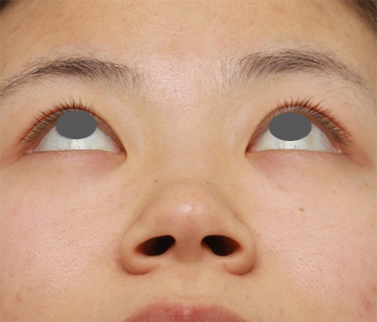 隆鼻術（シリコンプロテーゼ）,鼻のシリコンプロテーゼ+鼻翼（小鼻）縮小手術の症例写真,Before,ba_ryubi58_b.jpg