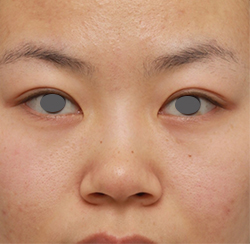 鼻翼縮小（小鼻縮小）,鼻のシリコンプロテーゼ+鼻翼（小鼻）縮小手術の症例写真,手術前,mainpic_ryubi14a.jpg