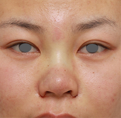 隆鼻術（シリコンプロテーゼ）,鼻のシリコンプロテーゼ+鼻翼（小鼻）縮小手術の症例写真,手術直後,mainpic_ryubi14b.jpg