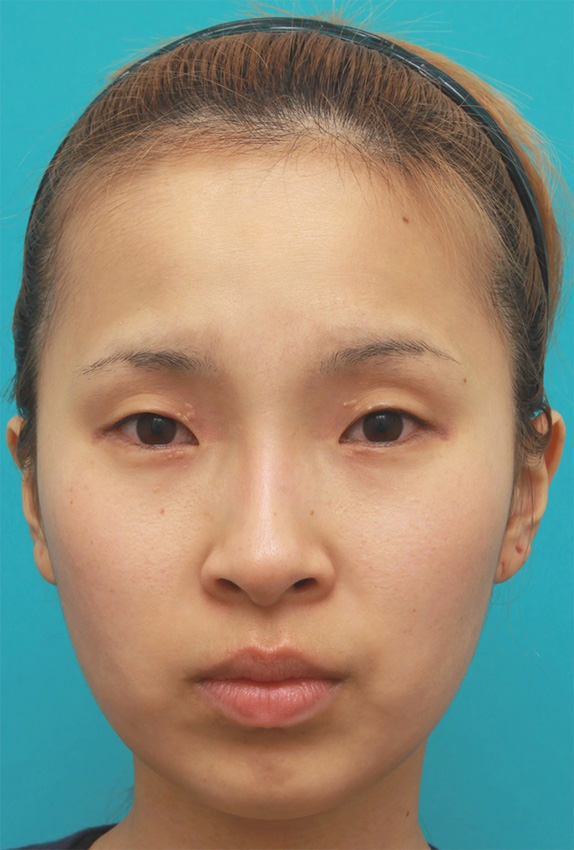 隆鼻術（シリコンプロテーゼ）,眉間プロテーゼ,眉間~鼻根~鼻背にかけてシリコンプロテーゼを入れ、鼻筋を通して高くした症例写真の画像,After（2ヶ月後）,ba_ryubi59_a01.jpg