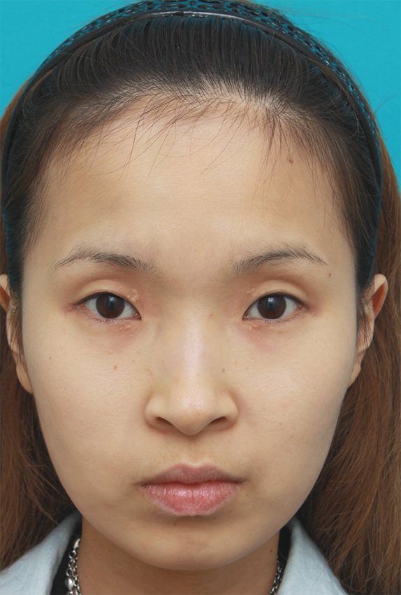 眉間プロテーゼ,眉間~鼻根~鼻背にかけてシリコンプロテーゼを入れ、鼻筋を通して高くした症例写真の画像,Before,ba_ryubi59_b.jpg