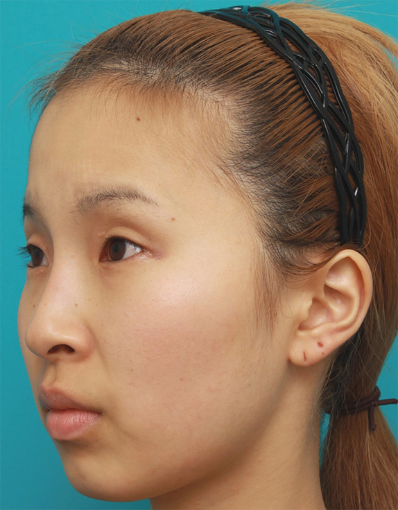 眉間プロテーゼ,眉間~鼻根~鼻背にかけてシリコンプロテーゼを入れ、鼻筋を通して高くした症例写真の画像,After（2ヶ月後）,ba_ryubi60_b.jpg