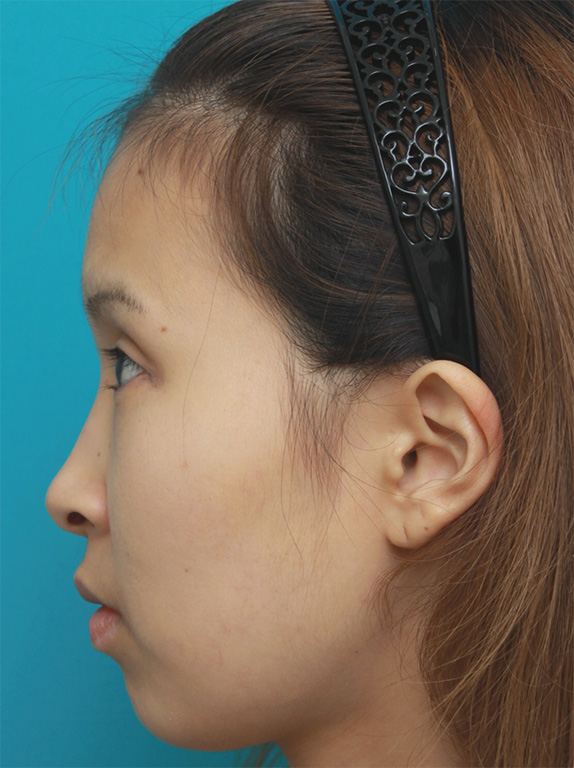 隆鼻術（シリコンプロテーゼ）,眉間~鼻根~鼻背にかけてシリコンプロテーゼを入れ、鼻筋を通して高くした症例写真の画像,Before,ba_ryubi61_b.jpg