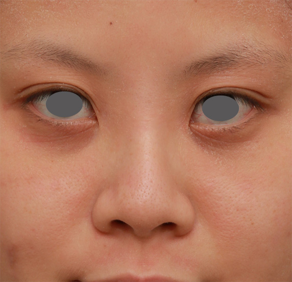 顔の印象をあまり変えないように鼻にシリコンプロテーゼを入れた症例写真,After（1年後）,ba_ryubi62_a01.jpg