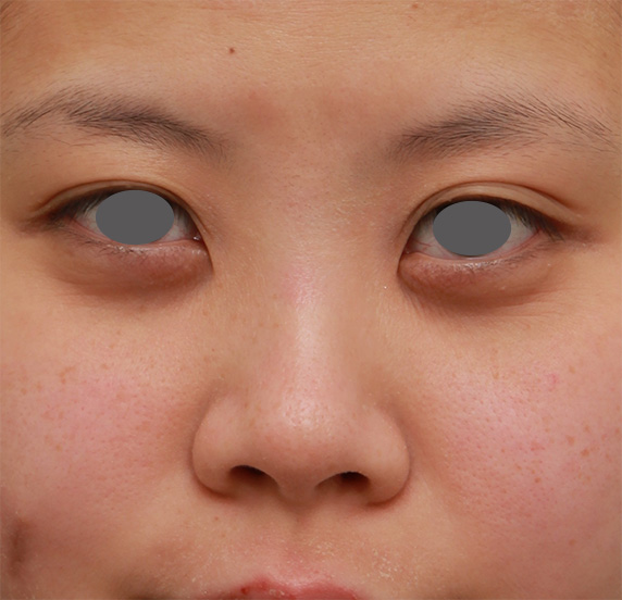 隆鼻術（シリコンプロテーゼ）,顔の印象をあまり変えないように鼻にシリコンプロテーゼを入れた症例写真,Before,ba_ryubi62_b.jpg
