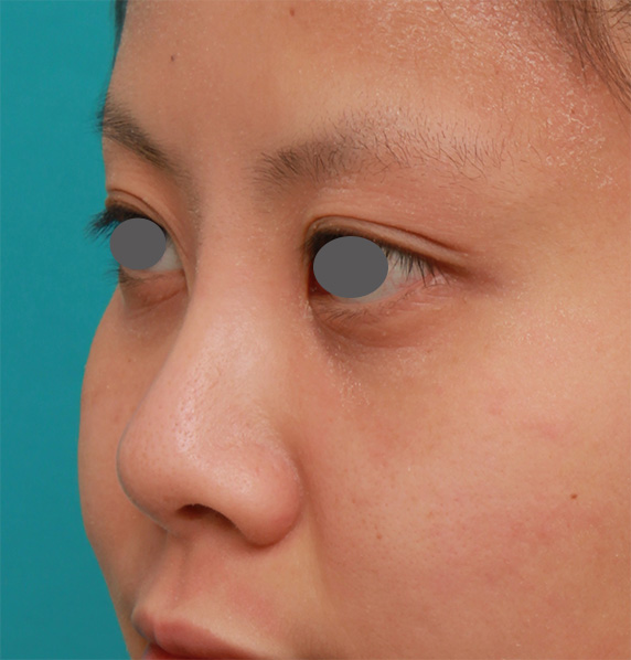 隆鼻術（シリコンプロテーゼ）,顔の印象をあまり変えないように鼻にシリコンプロテーゼを入れた症例写真,After（1年後）,ba_ryubi63_b.jpg