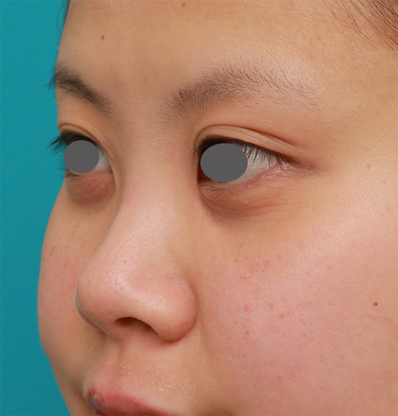 症例写真,顔の印象をあまり変えないように鼻にシリコンプロテーゼを入れた症例写真,Before,ba_ryubi63_b.jpg