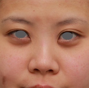隆鼻術（シリコンプロテーゼ）,顔の印象をあまり変えないように鼻にシリコンプロテーゼを入れた症例写真,手術前,mainpic_ryubi15a.jpg