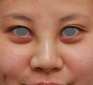 隆鼻術（シリコンプロテーゼ）,顔の印象をあまり変えないように鼻にシリコンプロテーゼを入れた症例写真,手術直後,mainpic_ryubi15b.jpg