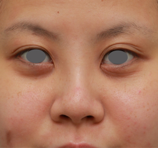 隆鼻術（シリコンプロテーゼ）,顔の印象をあまり変えないように鼻にシリコンプロテーゼを入れた症例写真,1週間後,mainpic_ryubi15c.jpg