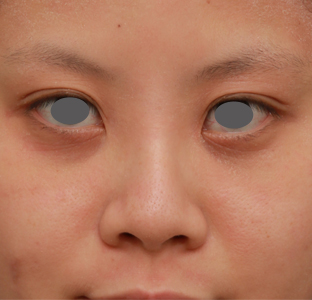 隆鼻術（シリコンプロテーゼ）,顔の印象をあまり変えないように鼻にシリコンプロテーゼを入れた症例写真,1年後,mainpic_ryubi15d.jpg