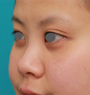 隆鼻術（シリコンプロテーゼ）,顔の印象をあまり変えないように鼻にシリコンプロテーゼを入れた症例写真,手術前,mainpic_ryubi15e.jpg