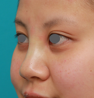 症例写真,顔の印象をあまり変えないように鼻にシリコンプロテーゼを入れた症例写真,手術直後,mainpic_ryubi15f.jpg