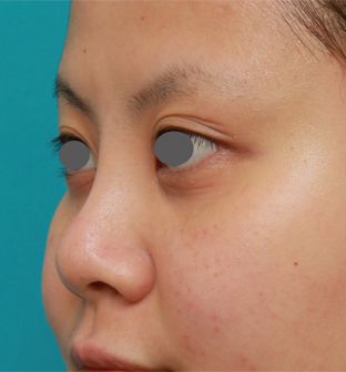 隆鼻術（シリコンプロテーゼ）,顔の印象をあまり変えないように鼻にシリコンプロテーゼを入れた症例写真,1週間後,mainpic_ryubi15g.jpg