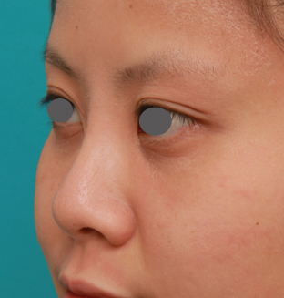 隆鼻術（シリコンプロテーゼ）,顔の印象をあまり変えないように鼻にシリコンプロテーゼを入れた症例写真,1年後,mainpic_ryubi15h.jpg