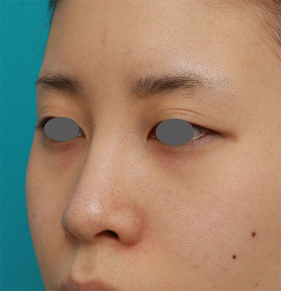 隆鼻術（シリコンプロテーゼ）,鼻に注入されたヒアルロン酸をヒアルロニダーゼで溶かすのと同時にシリコンプロテーゼ+耳介軟骨移植をした症例写真の術前術後画像,After（6ヶ月後）,ba_ryubi65_b.jpg