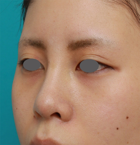 他院で受けた手術の修正（鼻）,鼻に注入されたヒアルロン酸をヒアルロニダーゼで溶かすのと同時にシリコンプロテーゼ+耳介軟骨移植をした症例写真の術前術後画像,Before,ba_ryubi65_b.jpg
