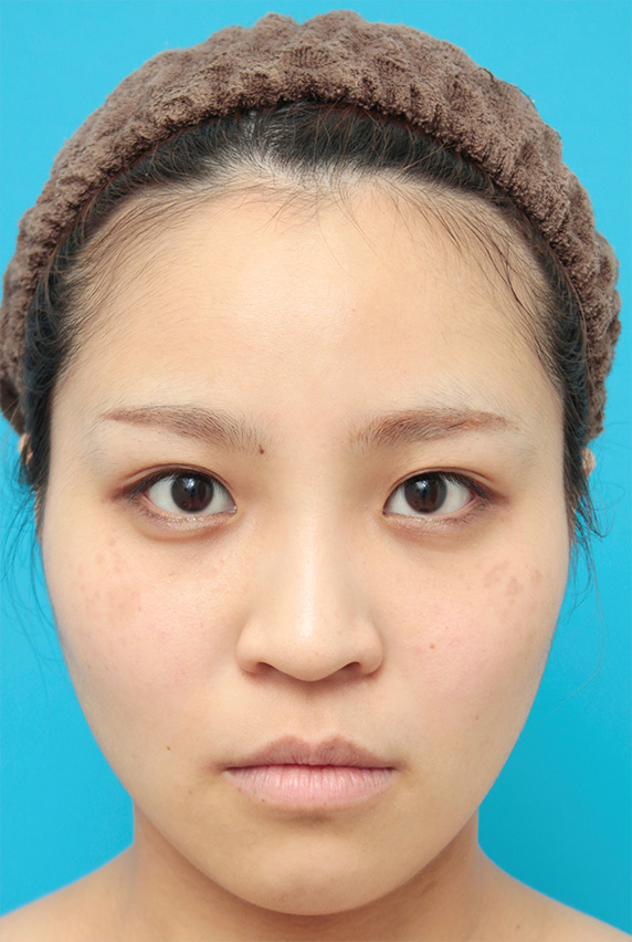 隆鼻術（シリコンプロテーゼ）,鼻に3mmのシリコンプロテーゼを入れ、自然に鼻筋を通した症例写真,After（6ヶ月後）,ba_ryubi67_b.jpg
